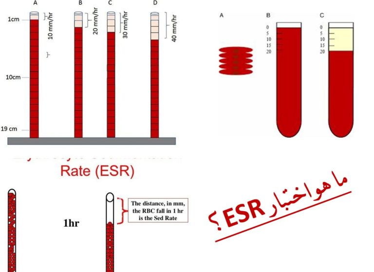 ما هو اختبار ESR؟